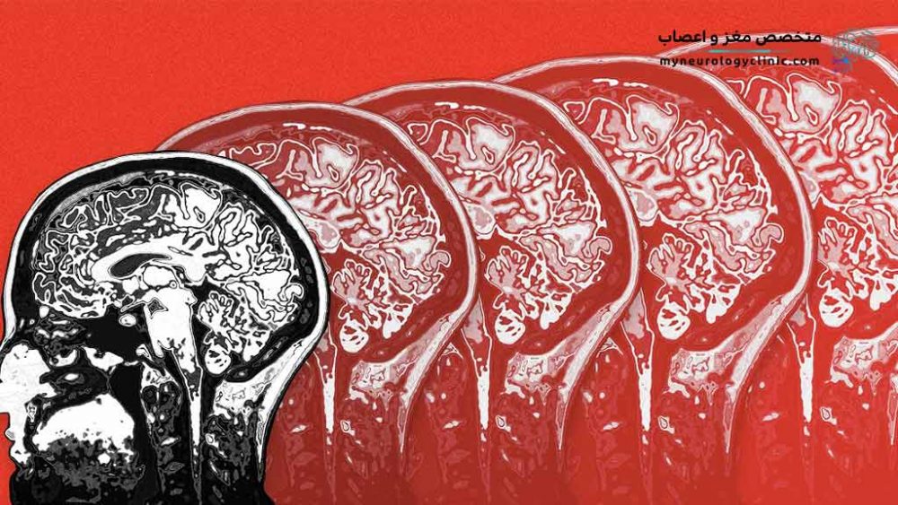 علت و درمان آنسفالیت مغز چیست؟