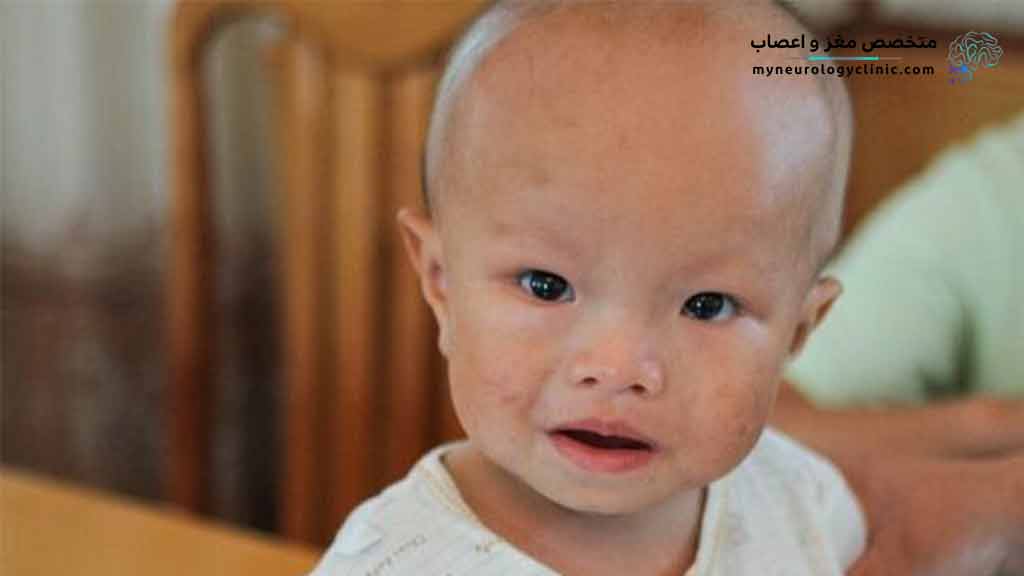 درمان آب آوردن مغز هیدروسفالی در شیراز