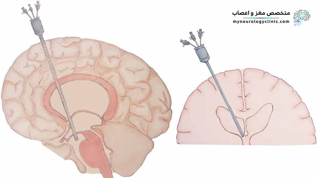 جراحی ونتریکولوستومی چیست؟
